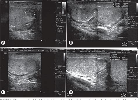 Figure 1 From Testicular Schistosomiasis As Differential Diagnosis For Testicular Nodules A