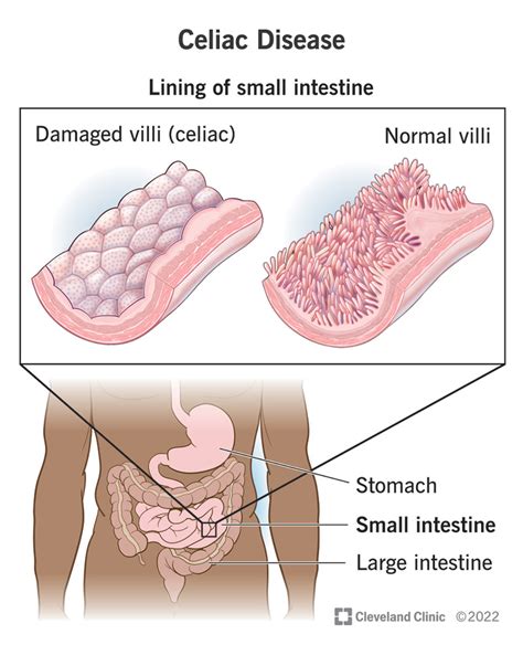 Celiac Disease Symptoms And How Its Treated