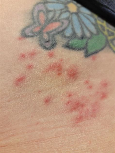 Can Anyone Tell Me About These Rashes Came From The Outerbanks Were We Caught A Couple Small