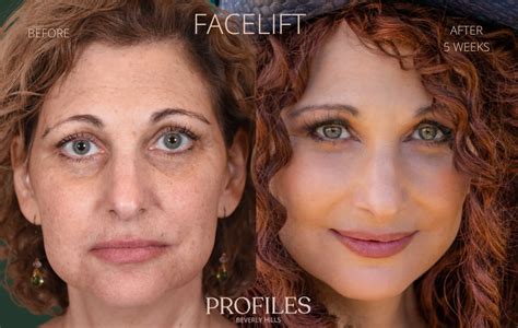 Face Lifts Before And After