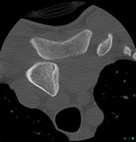 Posterior Dislocation Of Sternoclavicular Joint Image