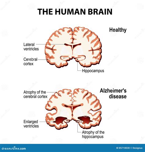 Cross Section Of The Human Brain With Alzheimer`s Disease Stock Vector