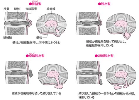 腰椎椎間板ヘルニアの特徴｜診断と治療法の決定｜腰椎椎間板ヘルニア｜治療と予防｜痛みの原因と治療法－qlife痛み