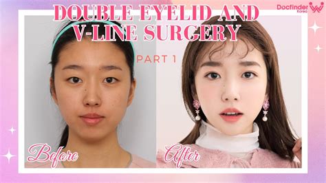 Plastic Surgery In Korea Experience Double Eyelid Surgery And V Line Part 1 Youtube