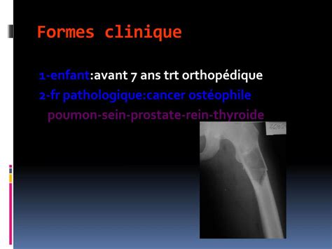 Ppt Fractures De La Diaphyse Femorale Powerpoint Presentation Free