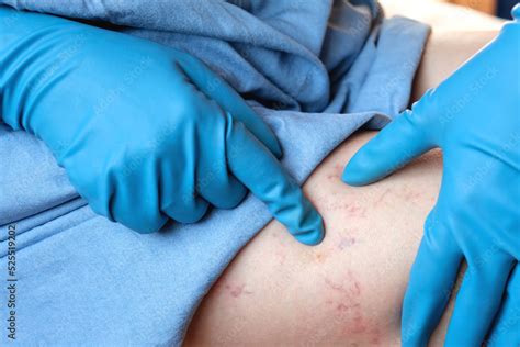 Phlebologist Examines A Patient With Varicose Veins On His Leg Leg