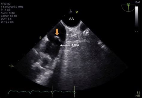 Intraoperative Tee Ascending Aortic Arch Short Axis View Demonstrating