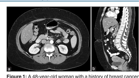 [PDF] Transdiscal Core Biopsy of Aortocaval Lymph Node: A Case Report ...