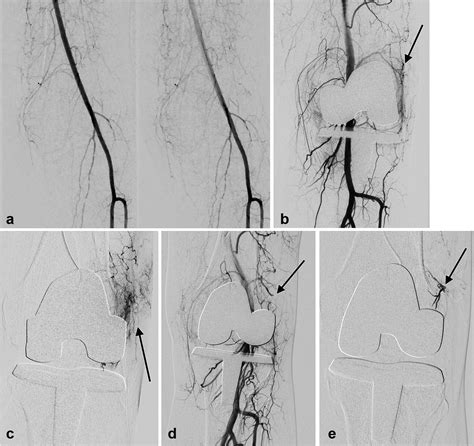 Genicular Artery Embolization For Refractory Hemarthrosis Following