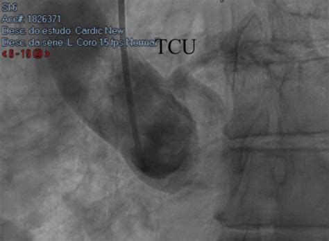 SciELO Brasil Acute Coronary Syndrome In A Patient With Single