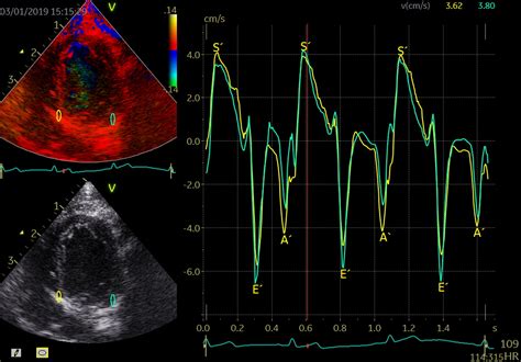 Tissue Doppler Echocardiography K Benhavns Universitet