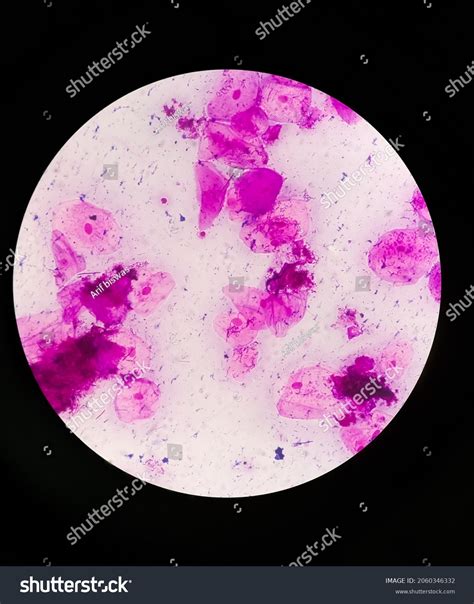 Prostatic Smear Ps Gram Stain Microscopic Stock Photo