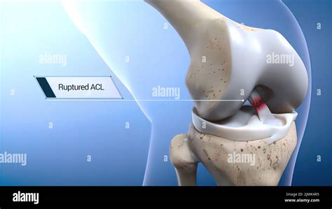 Lesi N De Ligamento Cruzado Anterior