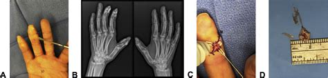 The Scleroderma Hand: Manifestations of Disease and Approach to ...