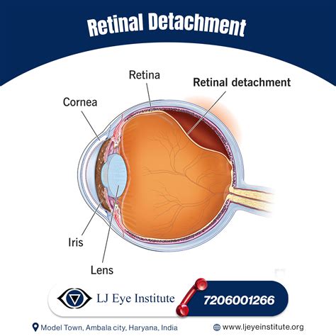 Retinal Detachment Lj Eye Institute