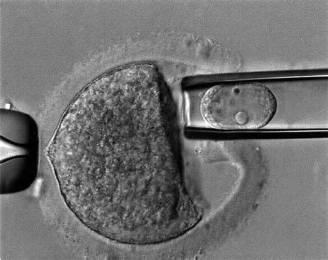 Transfer Of An Isolated Human Germinal Vesicle Karyoplast Into An