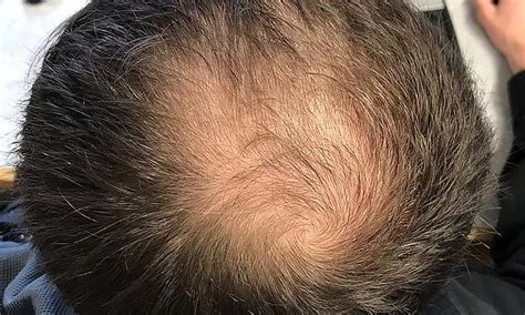 Scientists Develop New Technique To Reverse Balding By Transplanting