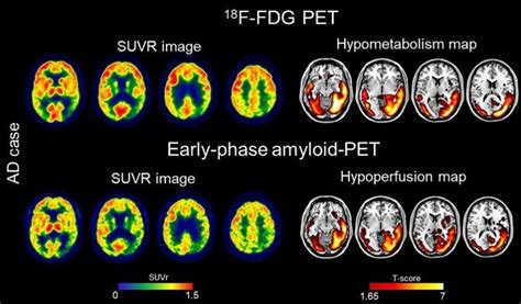 Pet Scan Brain Dementia