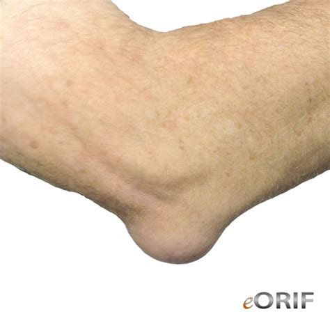 Olecranon Bursitis M70.20 726.33 | eORIF