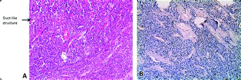 Photomicrograph Of Myoepithelioma A Showing Few Spindle Shaped Tumor