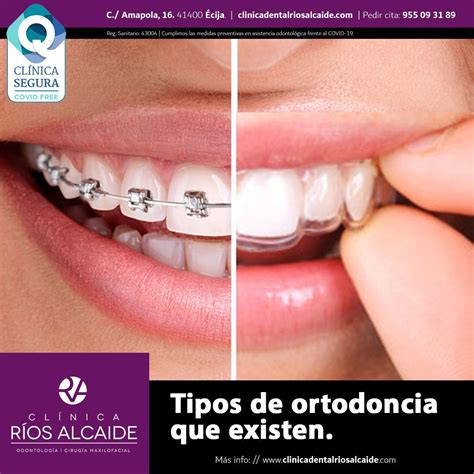 ¿qué Tipos De Ortodoncia Existen Clínica Dental Ríos Alcaide Tú Clínica Dental En Écija