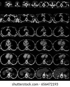 Computed Tomography Ct Scan Chest Abdomen Stock Photo