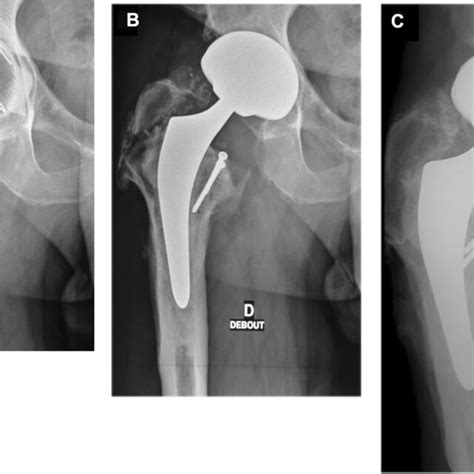 A Pre Revision Radiograph Of The Former Cemented Stem In A Hip With Download Scientific Diagram