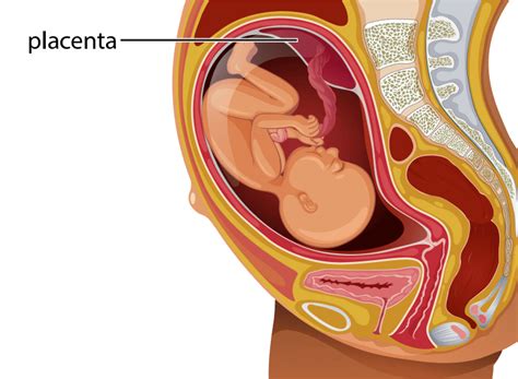 Placenta Previa Birth Injury Center