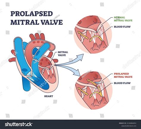 Prolapsed Mitral Valve Heart Disease Comparison Stock Vector Royalty