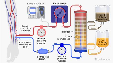 Hemodialysis Vs Peritoneal Dialysis Differences Explained