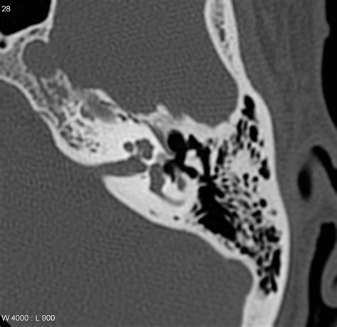 Fenestral Otosclerosis Image