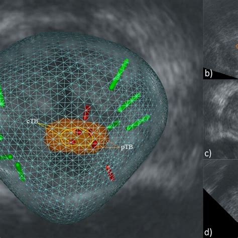 Patient Specific 3d Prostate Map After Mri Targeted And Systematic Download Scientific Diagram