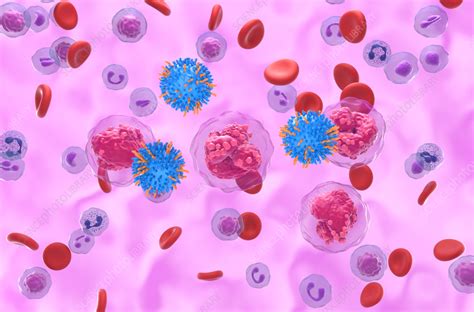 Car T Cell Therapy For Acute Lymphoblastic Leukaemia Illustration