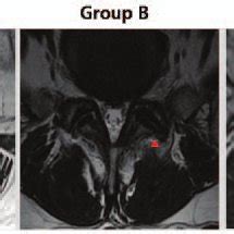 Grading of facet joint osteoarthritis in representative T2-weighted ...