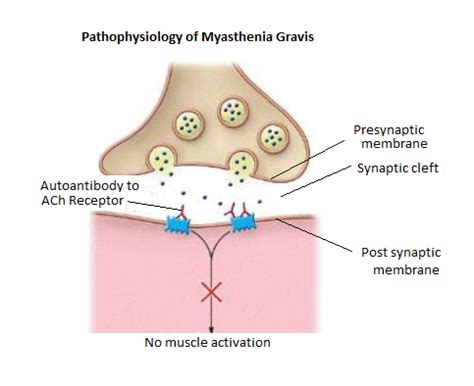 Myasthenia Gravis Rcemlearning