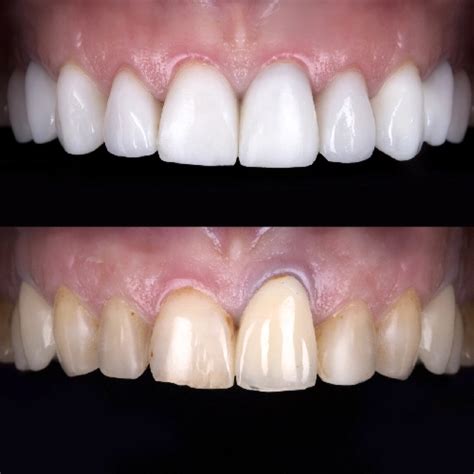 Smile Transformation Dentfirst Dental Care