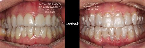 Nova Geração de Alinhadores em Ortodontia Mais Rápido e Invisível