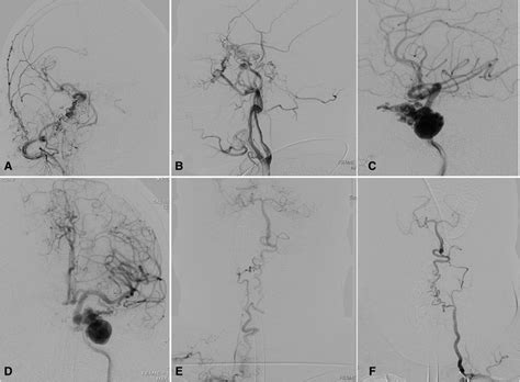 Complicated Rete Aneurysm With Bilateral ICA Agenesis In A 65 Year Old