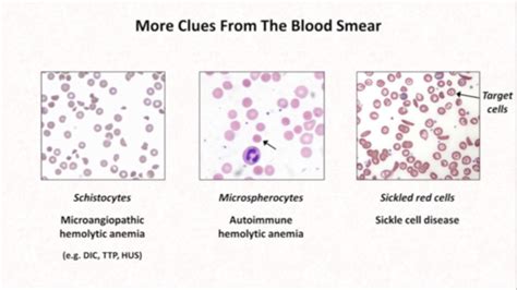 Hemolytic Anemia Flashcards Quizlet