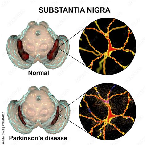 Substantia Nigra In Norm And In Parkinson S Disease D Illustration