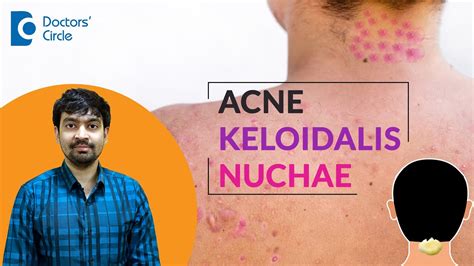 Pimples On Neck Back Of Head Acne Keloidalis Nuchae Treatment Dr