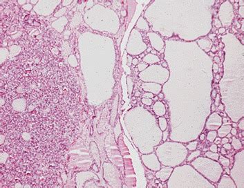 Thyroid Nodules Endotext NCBI Bookshelf