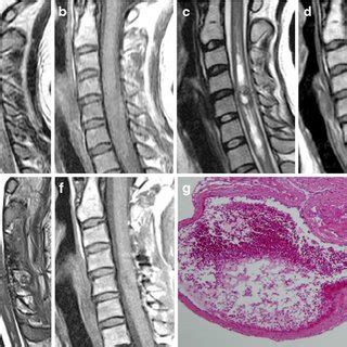 Case 12. CM located at the cervicomedullary junction. a - c ...