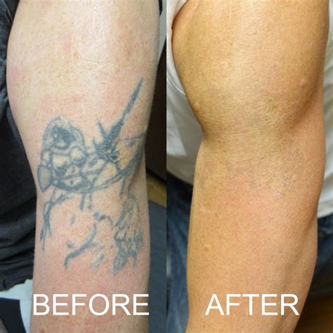 Tattoo Removal Before After Before And After Photos