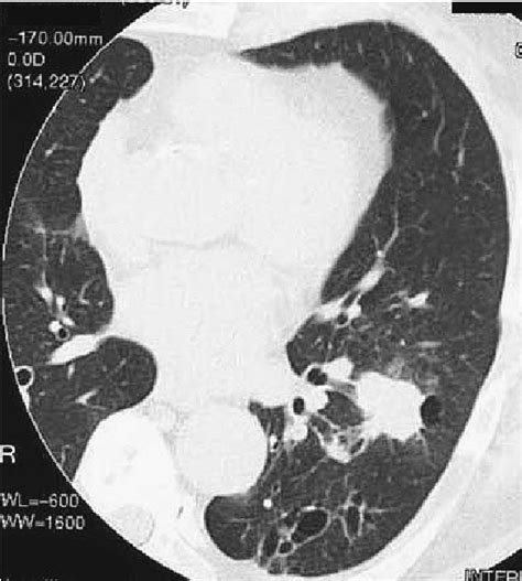 Figure 1 From A Case Of Pulmonary Lymphoepithelioma Like Carcinoma With