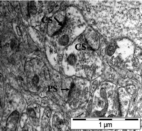 Electron Micrograph Of The Neuropil From Frontal Cortex Of Al