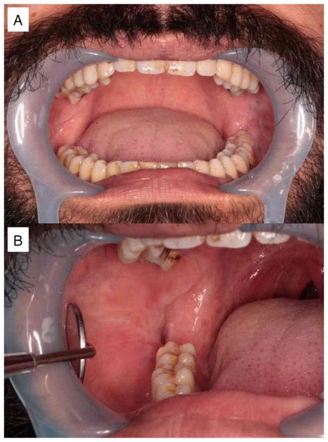 Odontogenic Keratocyst In The Mandibular Condyle Base Region A Case Report