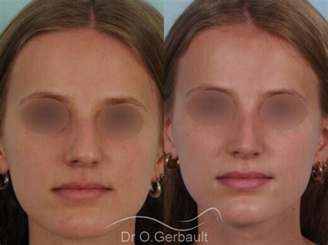 Rhinoplastie avant après photos et exemples de nez refaits