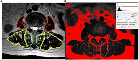 Measurement Of Cross Sectional Area And Intermuscular Fat Area Of