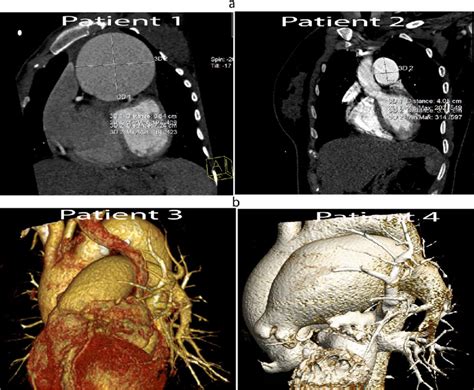 A CT Angiography With 128 Slices CT Scan Reconstructed Short Axis